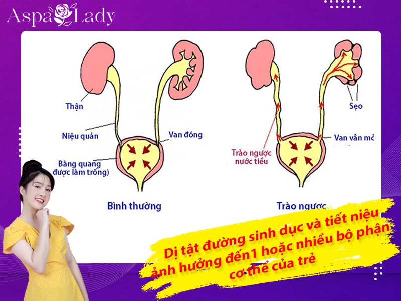 Dị tật đường sinh dục và tiết niệu ảnh hưởng đến1 hoặc nhiều bộ phận cơ thể của trẻ Dị tật đường sinh dục và tiết niệu ảnh hưởng đến1 hoặc nhiều bộ phận cơ thể của trẻ