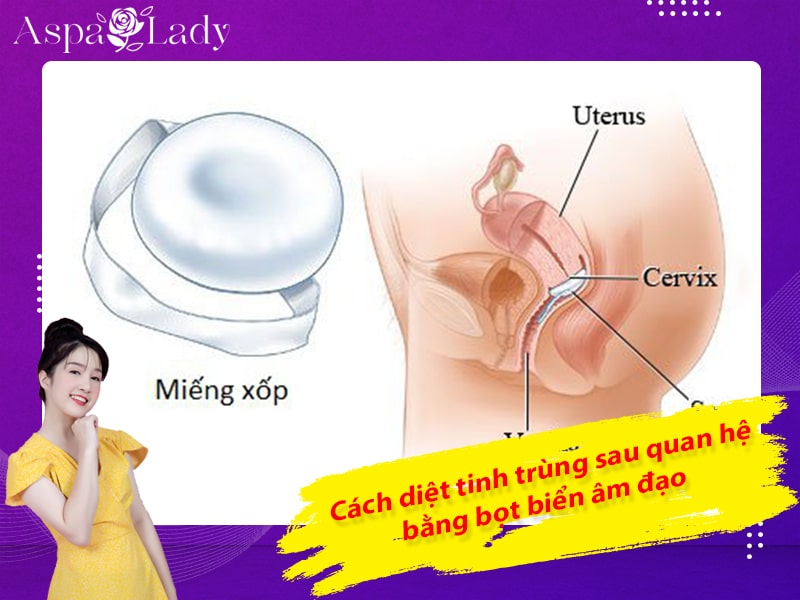 Cách diệt tinh trùng sau quan hệ bằng bọt biển âm đạo Cách diệt tinh trùng sau quan hệ bằng bọt biển âm đạo