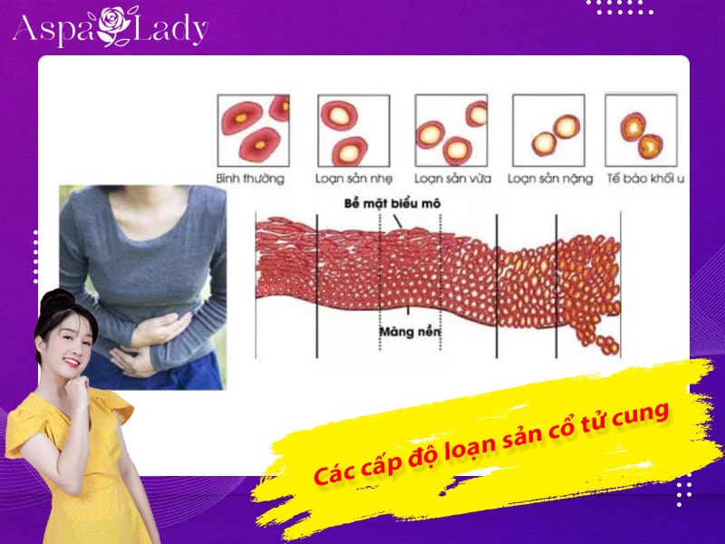 Các cấp độ loạn sản cổ tử cung