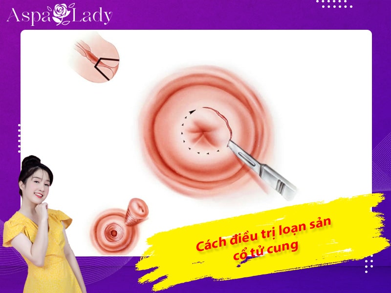 Cách điều trị loạn sản cổ tử cung