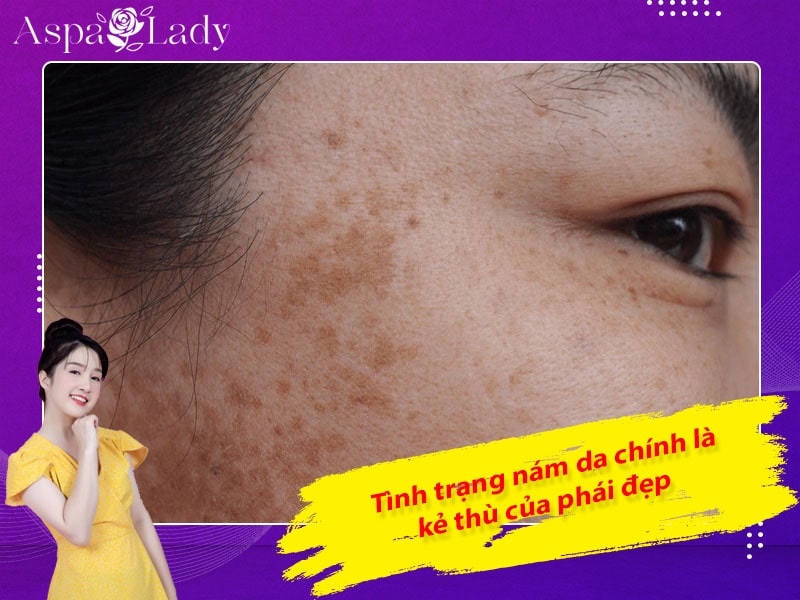 Tình trạng nám da chính là kẻ thù của phái đẹp