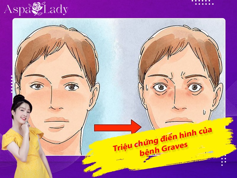 Triệu chứng điển hình của bệnh Graves Triệu chứng điển hình của bệnh Graves