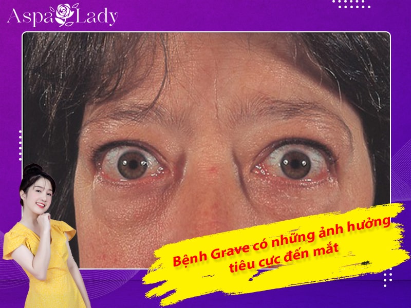 Bệnh Grave có những ảnh hưởng rất tiêu cực đến mắt Bệnh Grave có những ảnh hưởng rất tiêu cực đến mắt