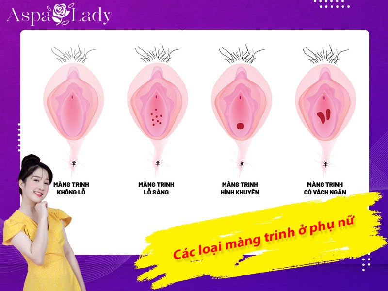 Các loại màng trinh ở phụ nữ Các loại màng trinh ở phụ nữ
