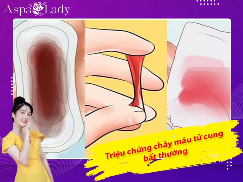 Triệu chứng chảy máu tử cung bất thường