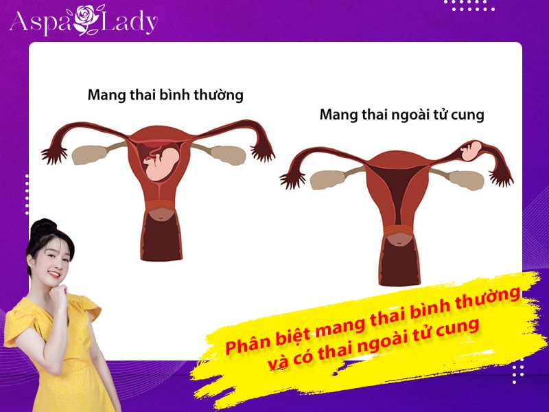 Phân biệt mang thai bình thường và có thai ngoài tử cung Phân biệt mang thai bình thường và có thai ngoài tử cung