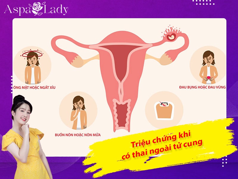 Triệu chứng khi có thai ngoài tử cung Triệu chứng khi có thai ngoài tử cung