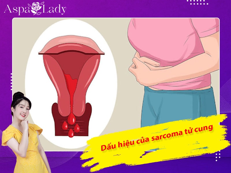 Dấu hiệu của sarcoma tử cung
