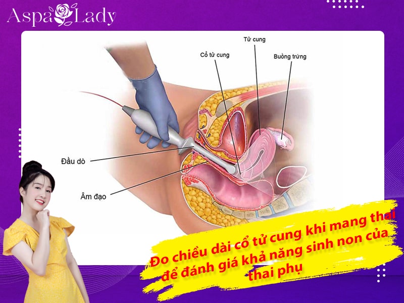 Đo chiều dài cổ tử cung khi mang thai để đánh giá khả năng sinh non của thai phụ Đo chiều dài cổ tử cung khi mang thai để đánh giá khả năng sinh non của thai phụ