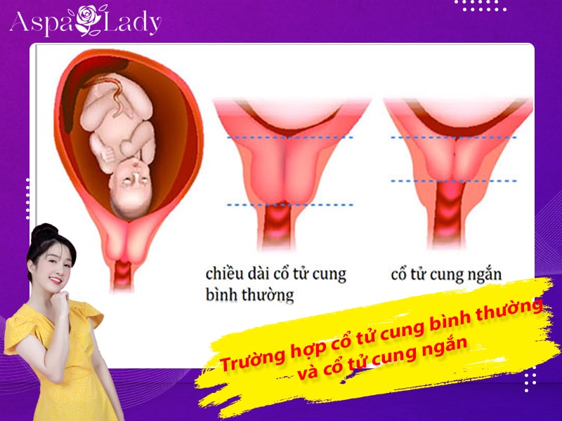 Trường hợp cổ tử cung bình thường và cổ tử cung ngắn Trường hợp cổ tử cung bình thường và cổ tử cung ngắn