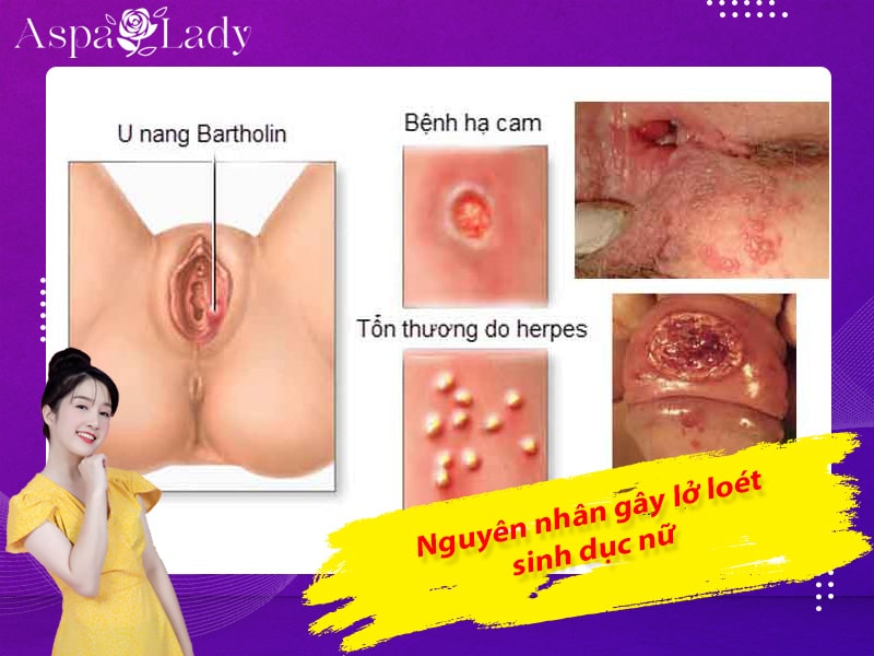 Nguyên nhân gây lở loét sinh dục nữ Nguyên nhân gây lở loét sinh dục nữ