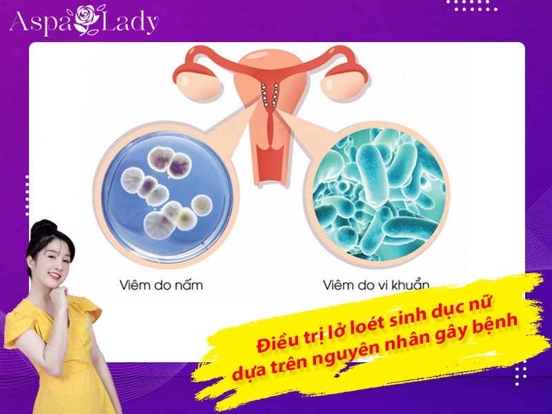 Điều trị lở loét sinh dục nữ dựa trên nguyên nhân gây bệnh Điều trị lở loét sinh dục nữ dựa trên nguyên nhân gây bệnh