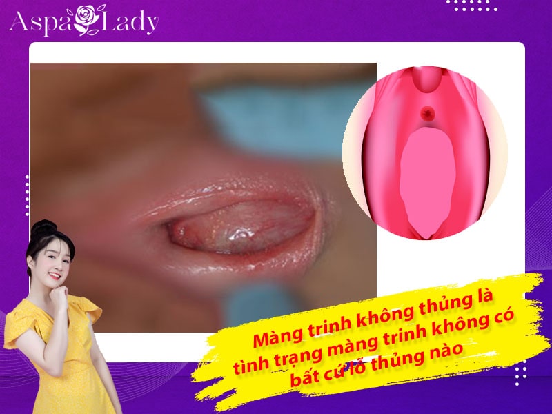 Màng trinh không thủng là tình trạng màng trinh không có bất cứ lỗ thủng nào. Màng trinh không thủng là tình trạng màng trinh không có bất cứ lỗ thủng nào.