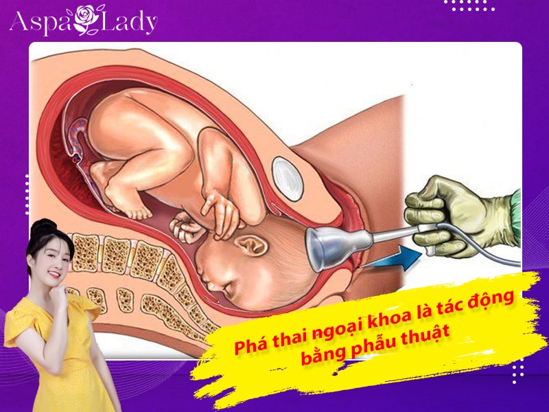 Phá thai ngoại khoa là tác động bằng phẫu thuật Phá thai ngoại khoa là tác động bằng phẫu thuật