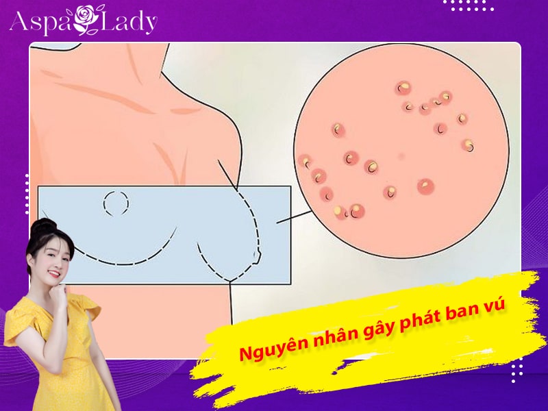 Nguyên nhân gây phát ban vú ở chị em phụ nữ Nguyên nhân gây phát ban vú ở chị em phụ nữ