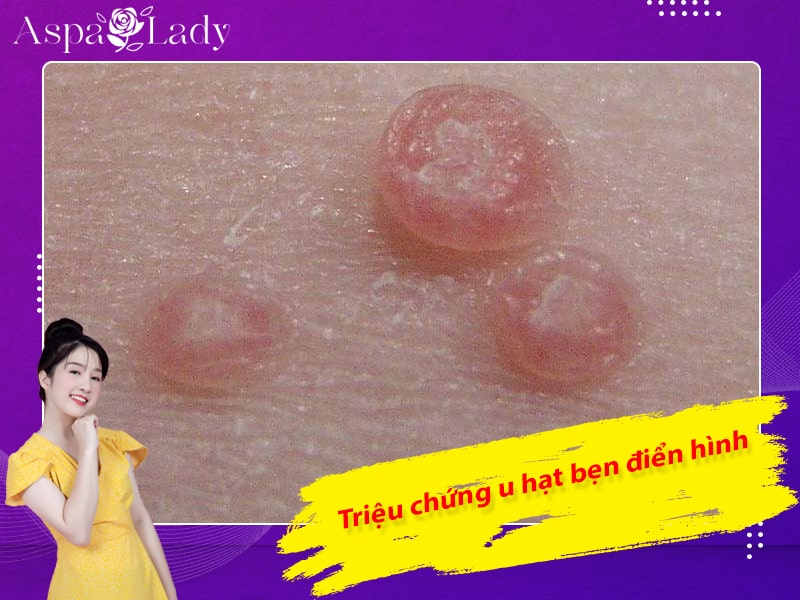 Triệu chứng u hạt bẹn điển hình Triệu chứng u hạt bẹn điển hình