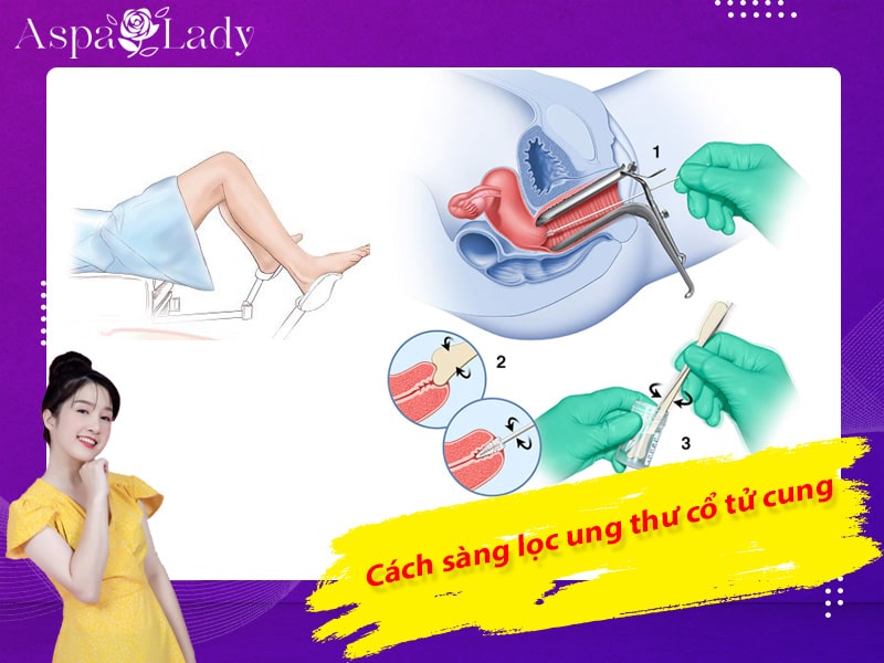 Cách sàng lọc ung thư cổ tử cung Cách sàng lọc ung thư cổ tử cung