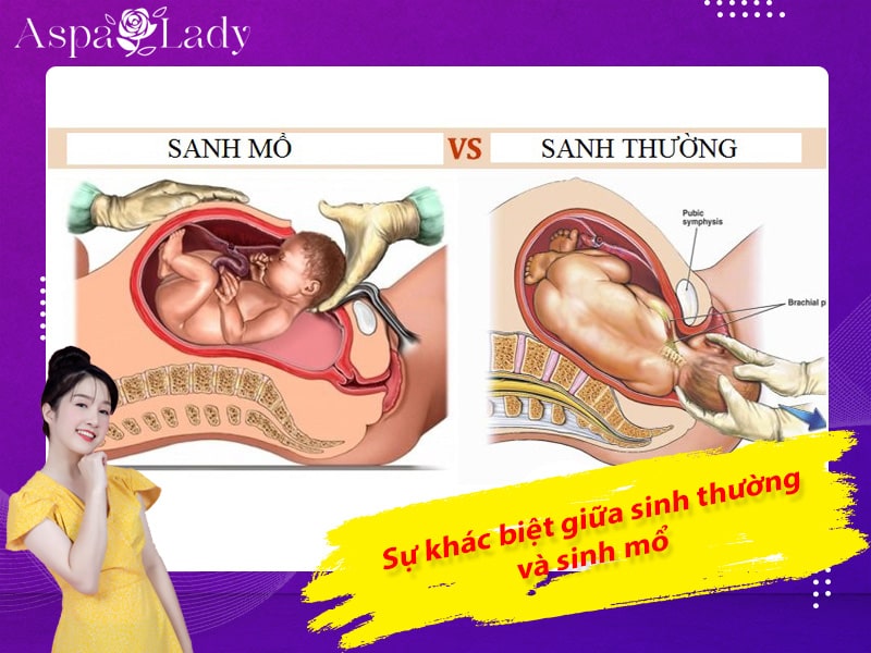 Sự khác biệt giữa sinh thường và sinh mổ