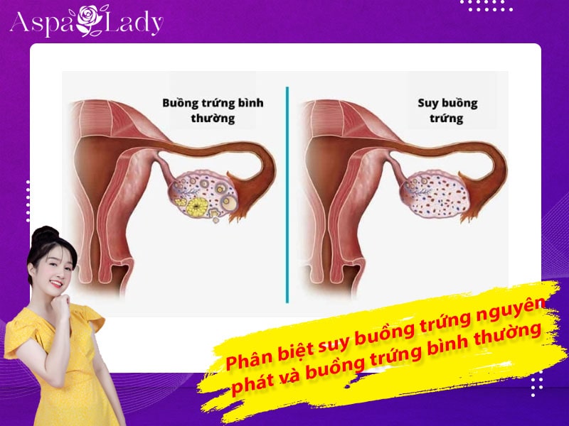 Phân biệt suy buồng trứng nguyên phát và buồng trứng bình thường