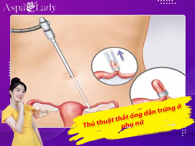 Thủ thuật thắt ống dẫn trứng ở phụ nữ Thủ thuật thắt ống dẫn trứng ở phụ nữ
