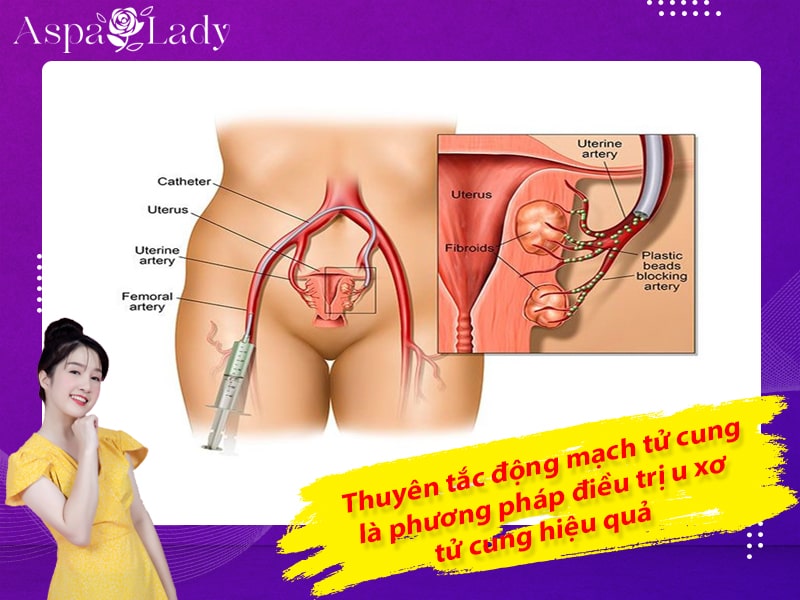 Thuyên tắc động mạch tử cung là phương pháp điều trị u xơ tử cung hiệu quả Thuyên tắc động mạch tử cung là phương pháp điều trị u xơ tử cung hiệu quả