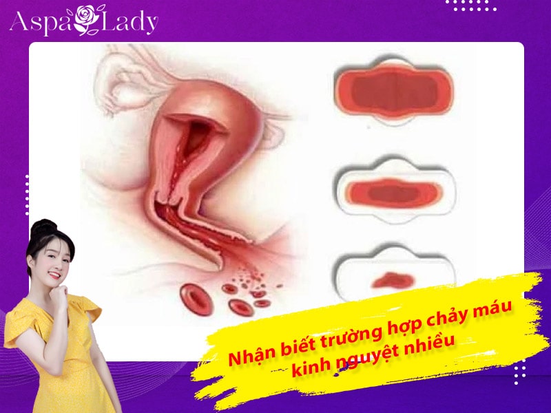 Nhận biết trường hợp chảy máu kinh nguyệt nhiều Nhận biết trường hợp chảy máu kinh nguyệt nhiều
