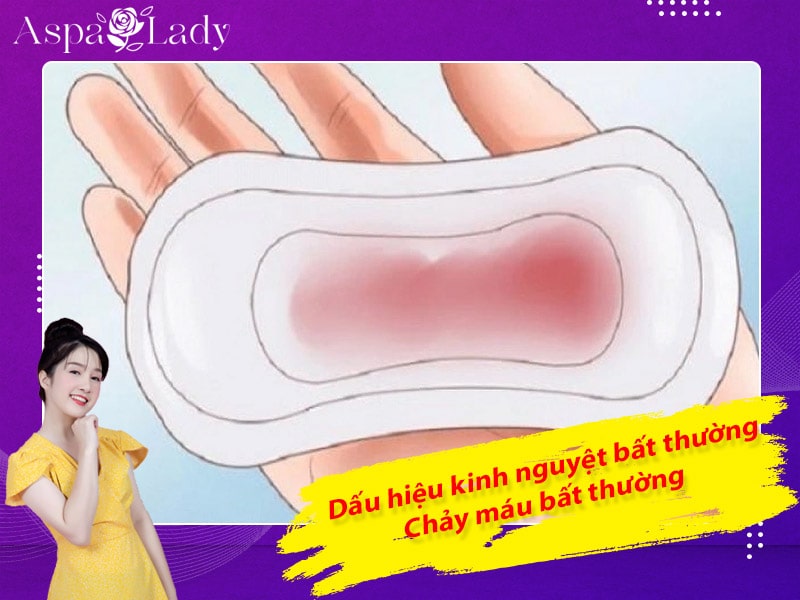 Dấu hiệu kinh nguyệt bất thường: Chảy máu bất thường Dấu hiệu kinh nguyệt bất thường: Chảy máu bất thường