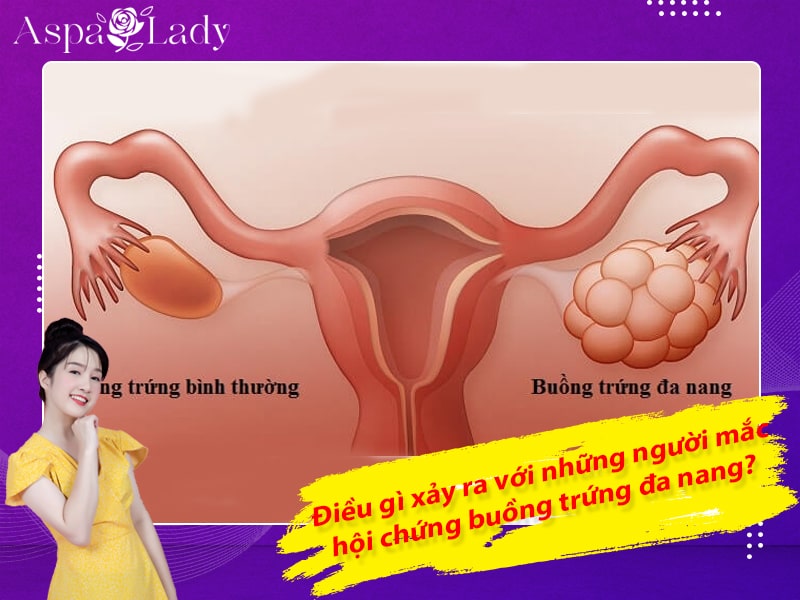 Điều gì xảy ra với những người mắc hội chứng buồng trứng đa nang Điều gì xảy ra với những người mắc hội chứng buồng trứng đa nang