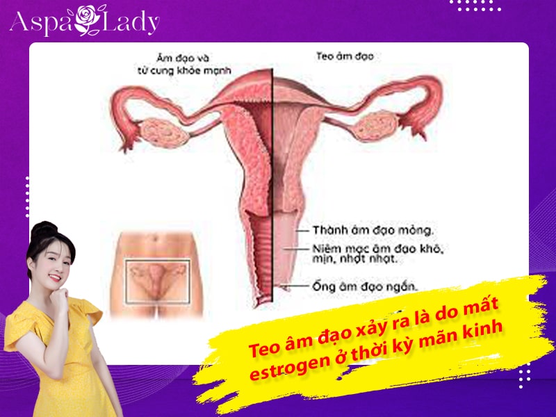 Teo âm đạo xảy ra là do mất estrogen ở thời kỳ mãn kinh Teo âm đạo xảy ra là do mất estrogen ở thời kỳ mãn kinh