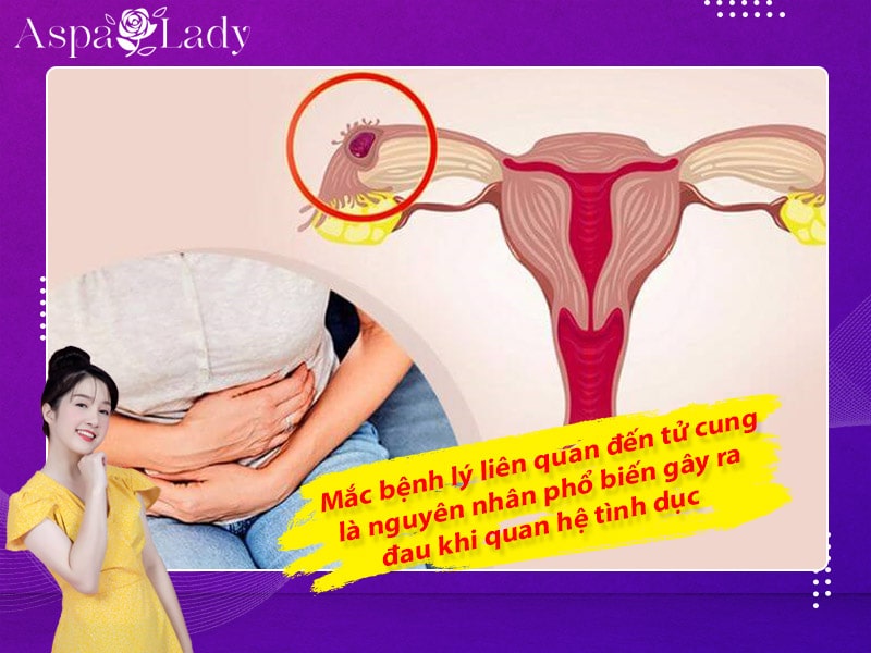Mắc bệnh lý liên quan đến tử cung là nguyên nhân phổ biến gây ra đau khi quan hệ tình dục Mắc bệnh lý liên quan đến tử cung là nguyên nhân phổ biến gây ra đau khi quan hệ tình dục