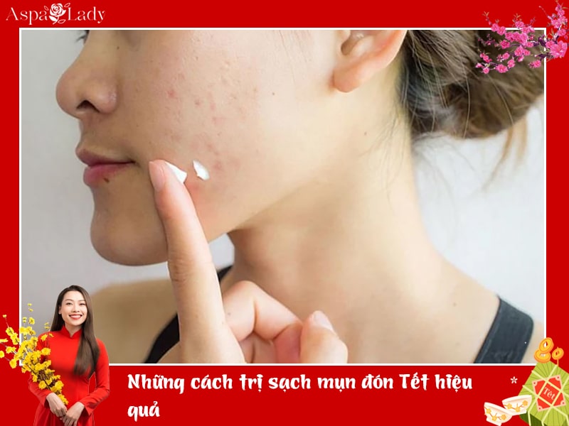 Những cách trị sạch mụn đón Tết hiệu quả Những cách trị sạch mụn đón Tết hiệu quả