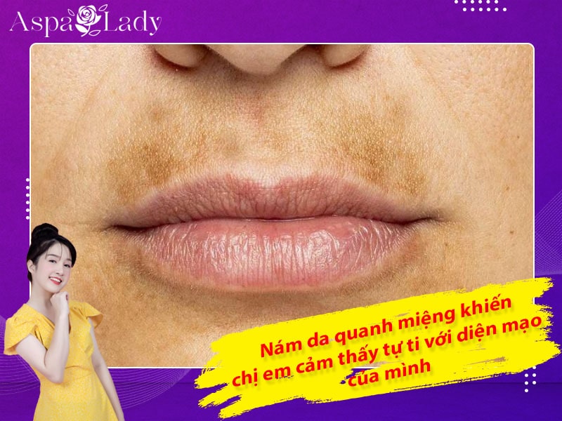 Nám da quanh miệng khiến chị em cảm thấy tự ti với diện mạo của mình