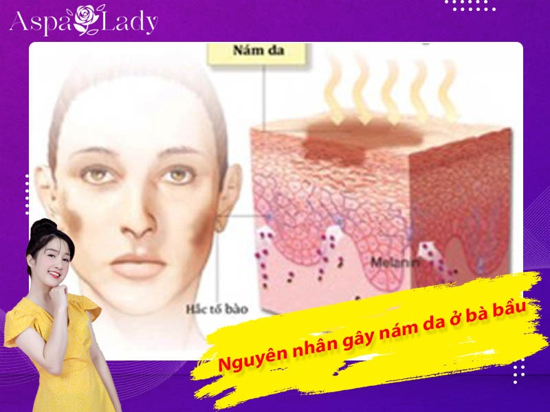 Nguyên nhân gây nám da ở bà bầu Nguyên nhân gây nám da ở bà bầu