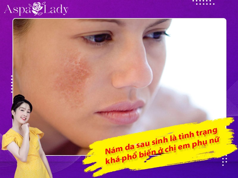 Nám da sau sinh là tình trạng khá phổ biến ở chị em phụ nữ Nám da sau sinh là tình trạng khá phổ biến ở chị em phụ nữ