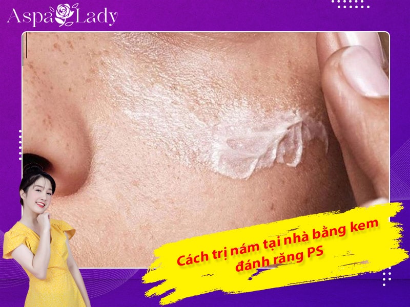 Cách trị nám tại nhà bằng kem đánh răng PS Cách trị nám tại nhà bằng kem đánh răng PS