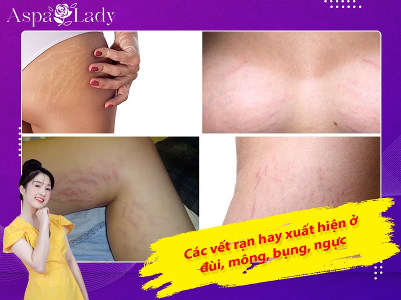 Các vết rạn hay xuất hiện ở đùi, mông, bụng, ngực Các vết rạn hay xuất hiện ở đùi, mông, bụng, ngực