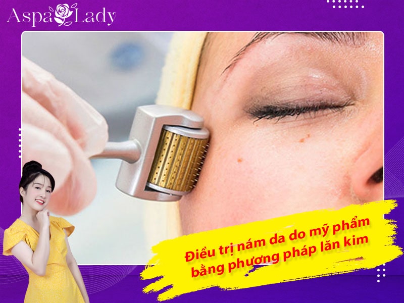 Điều trị nám da do mỹ phẩm bằng phương pháp lăn kim