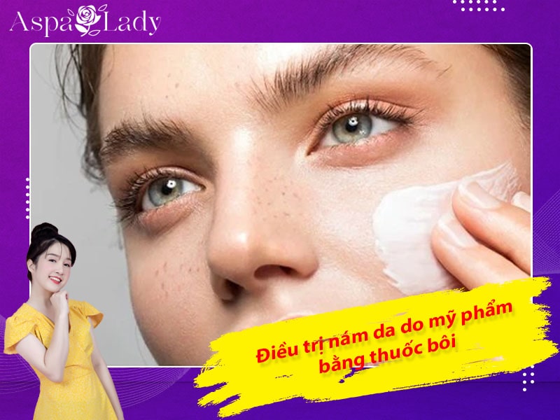 Điều trị nám do mỹ phẩm bằng thuốc bôi