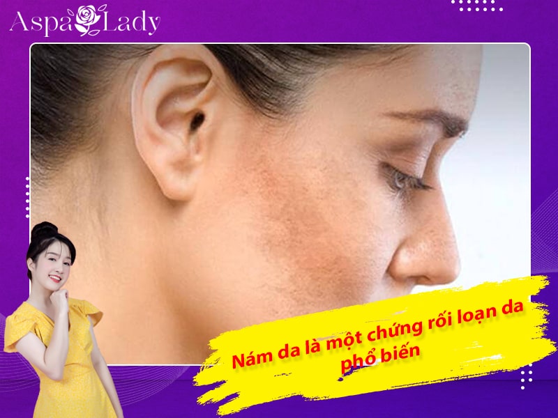 Nám da là một chứng rối loạn da phổ biến Nám da là một chứng rối loạn da phổ biến