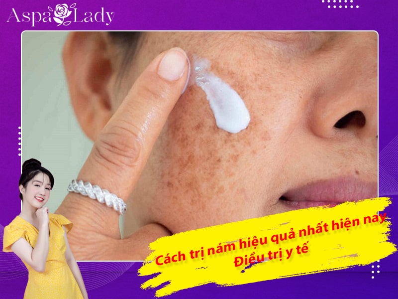 Cách trị nám hiệu quả nhất hiện nay: Điều trị y tế Cách trị nám hiệu quả nhất hiện nay: Điều trị y tế