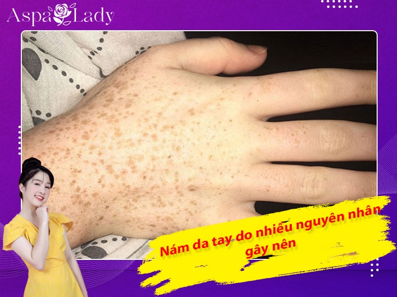 Nám da tay do nhiều nguyên nhân gây nên