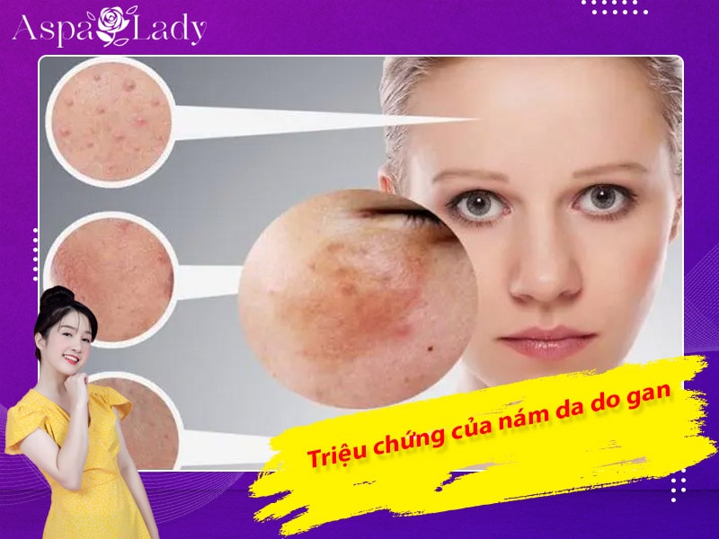 Triệu chứng của nám da do gan Triệu chứng của nám da do gan