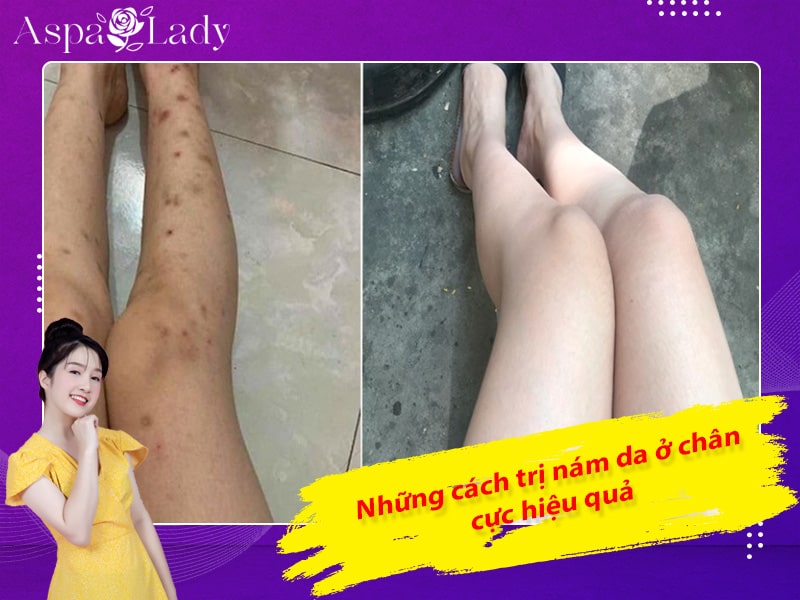 Những cách trị nám da ở chân cực hiệu quả Những cách trị nám da ở chân cực hiệu quả