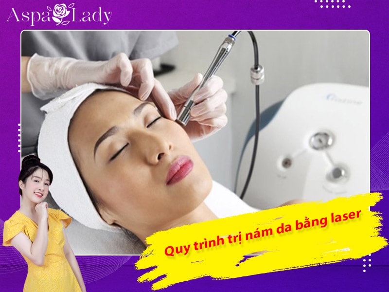 Quy trình trị nám da bằng laser Quy trình trị nám da bằng laser
