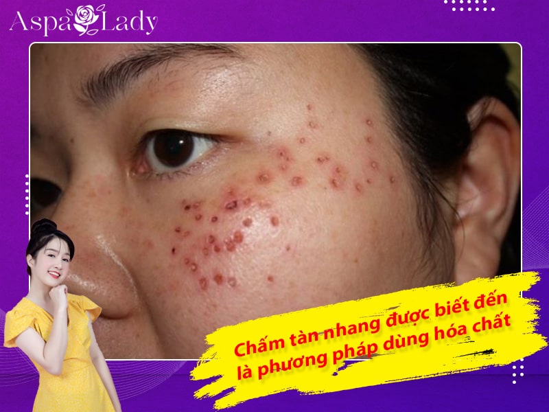 Chấm tàn nhang được biết đến là phương pháp dùng hóa chất Chấm tàn nhang được biết đến là phương pháp dùng hóa chất