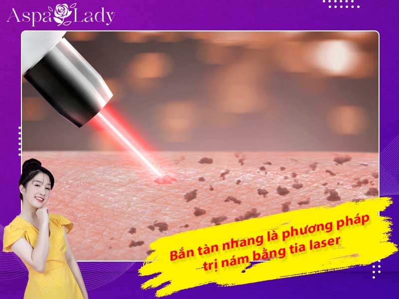 Bắn tàn nhang là phương pháp trị nám bằng tia laser Bắn tàn nhang là phương pháp trị nám bằng tia laser