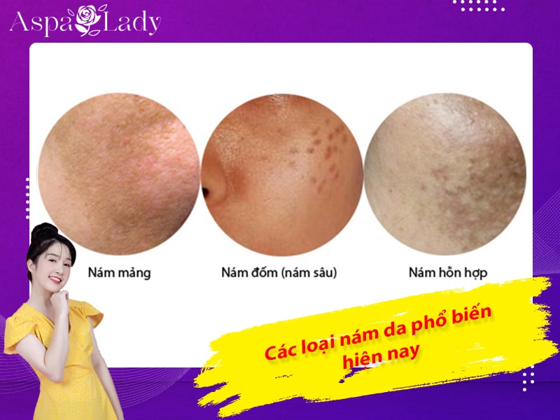 Các loại nám da phổ biến hiện nay