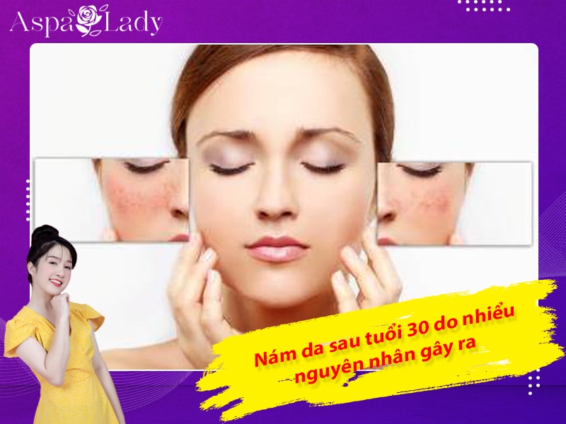 Nám da sau tuổi 30 do nhiều nguyên nhân gây ra Nám da sau tuổi 30 do nhiều nguyên nhân gây ra
