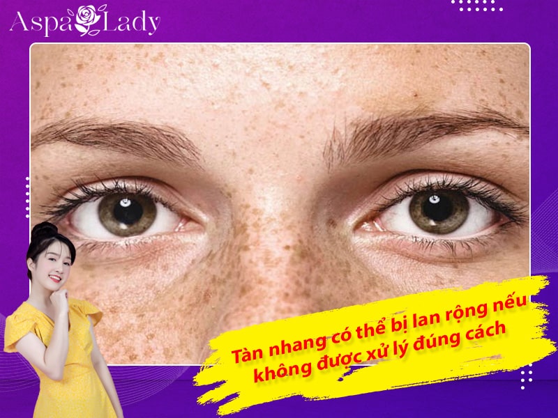 Tàn nhang có thể bị lan rộng nếu không được xử lý đúng cách Tàn nhang có thể bị lan rộng nếu không được xử lý đúng cách