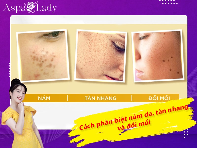 Cách phân biệt nám da, tàn nhang và đồi mồi Cách phân biệt nám da, tàn nhang và đồi mồi